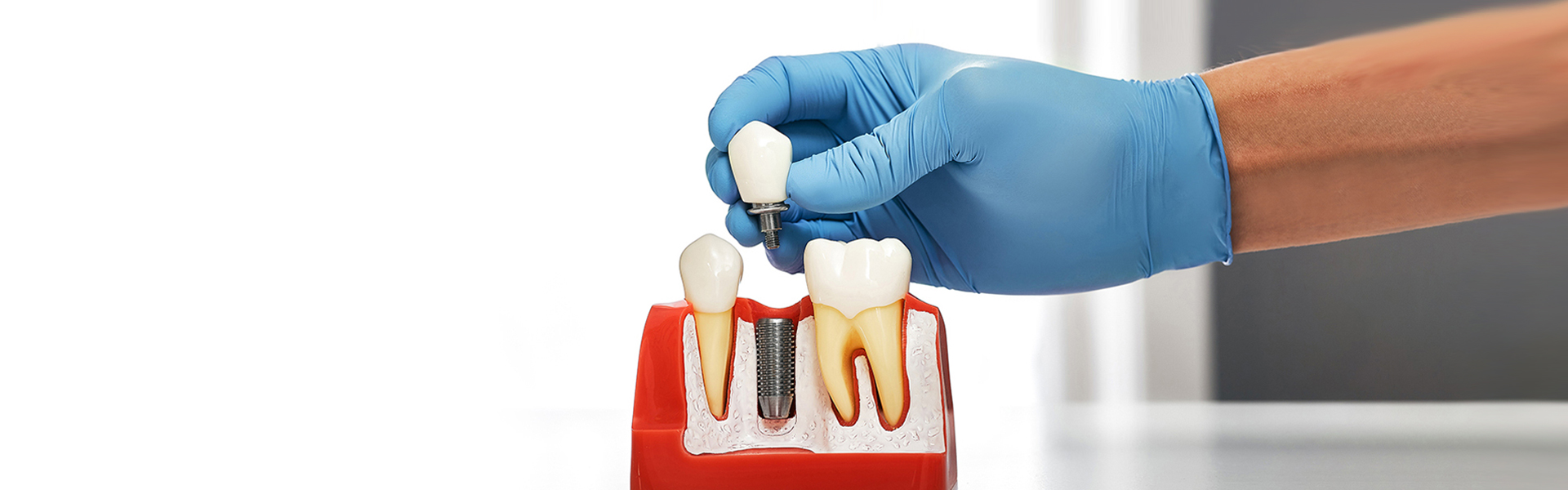 The Dental Implants Process: From Consultation to Final Restoration