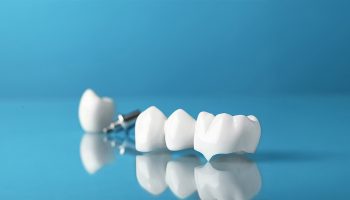 How Dental Crowns Restore Tooth Strength After Decay or Injury